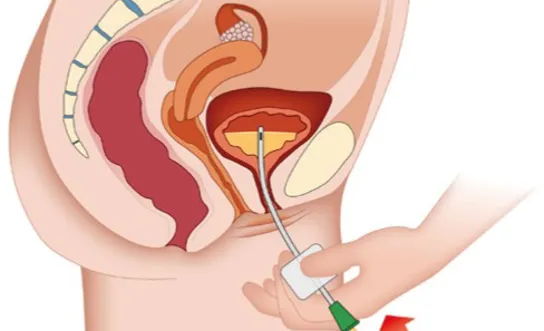 RH Herausgezogenen Katheter nicht mehr in die Blase vorschieben - Ratgeber Querschnittlähmung Herausgezogenen Katheter nicht mehr in die Blase vorschieben - Symbolbild für Ratgeber Querschnittlähmung