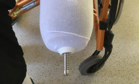 Prothesenhandling: Strumpf überziehen Prothesenhandling: Strumpf überziehen