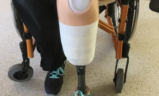 Prothesenhandling: Prothese anziehen 2 Prothesenhandling: Prothese anziehen 2