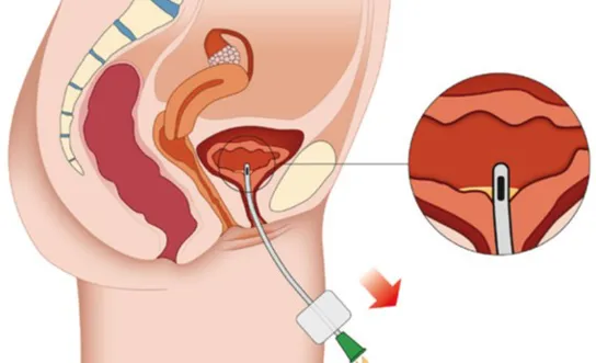 RH Herausgezogenen Katheter nicht mehr in die Blase vorschieben 1 (1) - Ratgeber Querschnitt Herausgezogenen Katheter nicht mehr in die Blase vorschieben 1 (1) - Ratgeber Querschnitt
