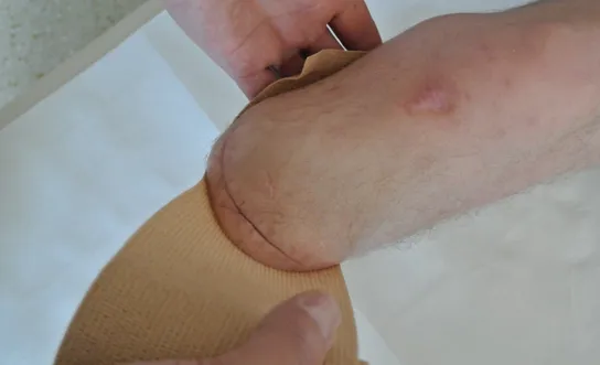 Stumpfbandage: Schritt 1 Stumpfbandage: Schritt 1