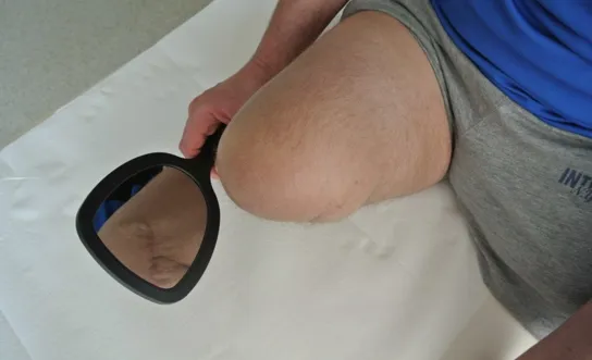 Hautkontrolle am Stumpf Hautkontrolle am Stumpf