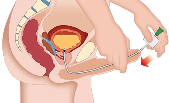 RH Katheter einführen (männl.) - Ratgeber Querschnittlähmung Katheter einführen (männl.) - Symbolbild für Ratgeber Querschnittlähmung