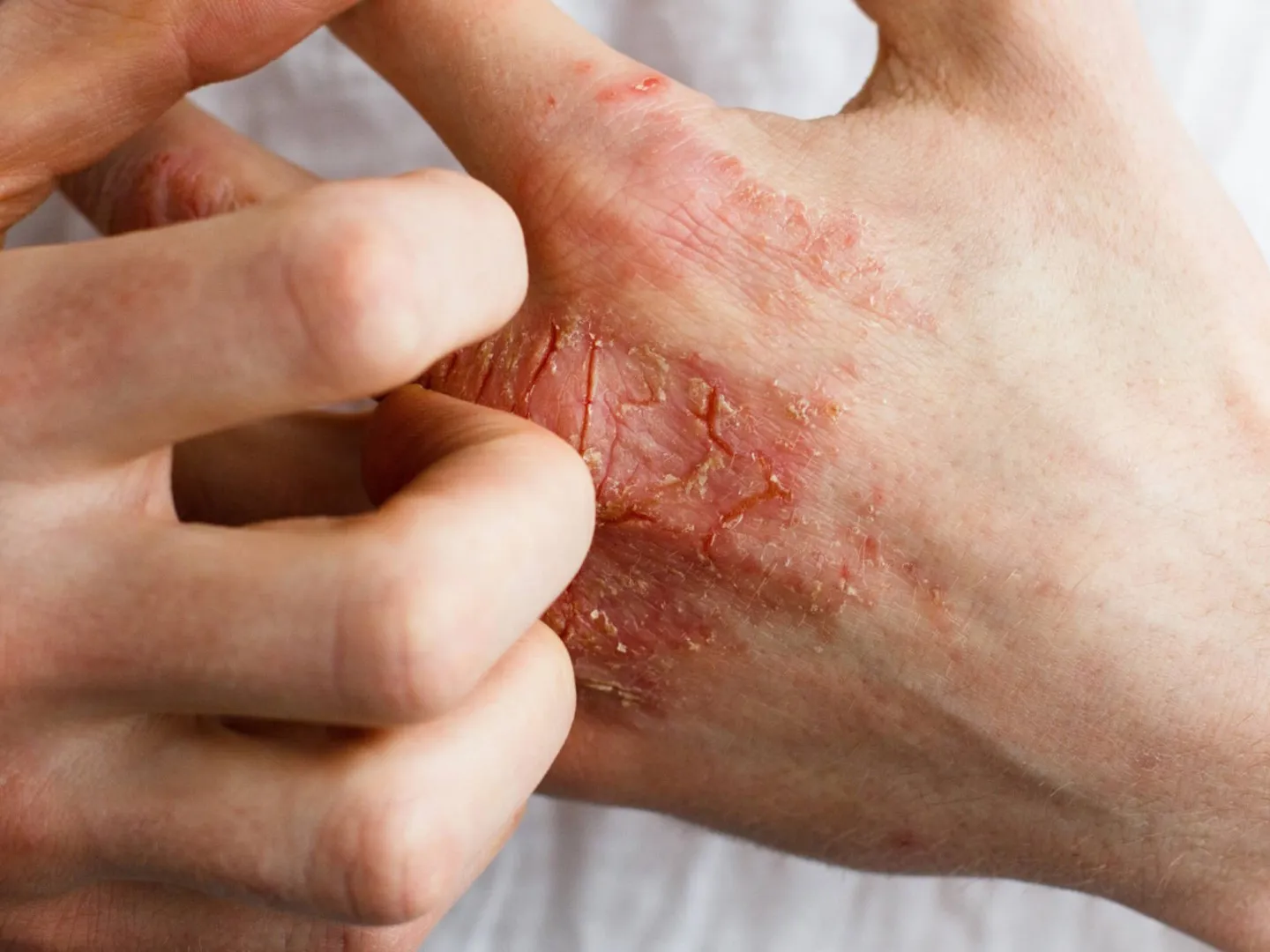 Hauterkrankungen 1440 ©Ольга Тернавская Adobe Stock Finger kratzen Handrücken mit Hautekzem