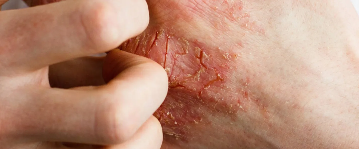 Hauterkrankungen 1440 ©Ольга Тернавская Adobe Stock Finger kratzen Handrücken mit Hautekzem