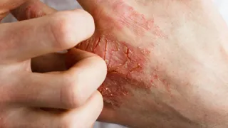 Hauterkrankungen 1440 ©Ольга Тернавская Adobe Stock Finger kratzen Handrücken mit Hautekzem