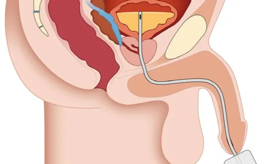 RH Katheter bis Anschlussstück in Blase vorschieben (männl.) - Ratgeber Querschnittlähmung Katheter bis zum Anschlussstück in die Blase vorschieben (männl.) - Symbolbild für Ratgeber Querschnittlähmung