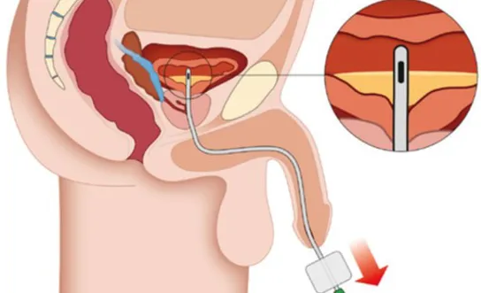 RH Herausziehen des Katheters - Ratgeber Querschnittlähmung Herausziehen des Katheters nach und nach um Blase vollstaendig - Symbolbild für Ratgeber Querschnittlähmung