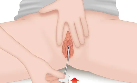 RH Labienkatheter - Ratgeber Querschnittlähmung Labienkatheter - Symbolbild für Ratgeber Querschnittlähmung